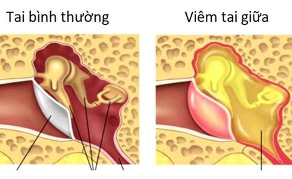 Viêm tai giữa là nguyên nhân phổ biến nhất gây đau tai